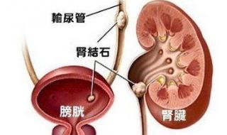 肾结石怎样治最好 肾结石怎样治最好