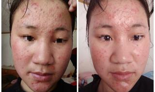 哪个医院的中医治痘痘效果好(广告勿进!) 祛痘最好的医院